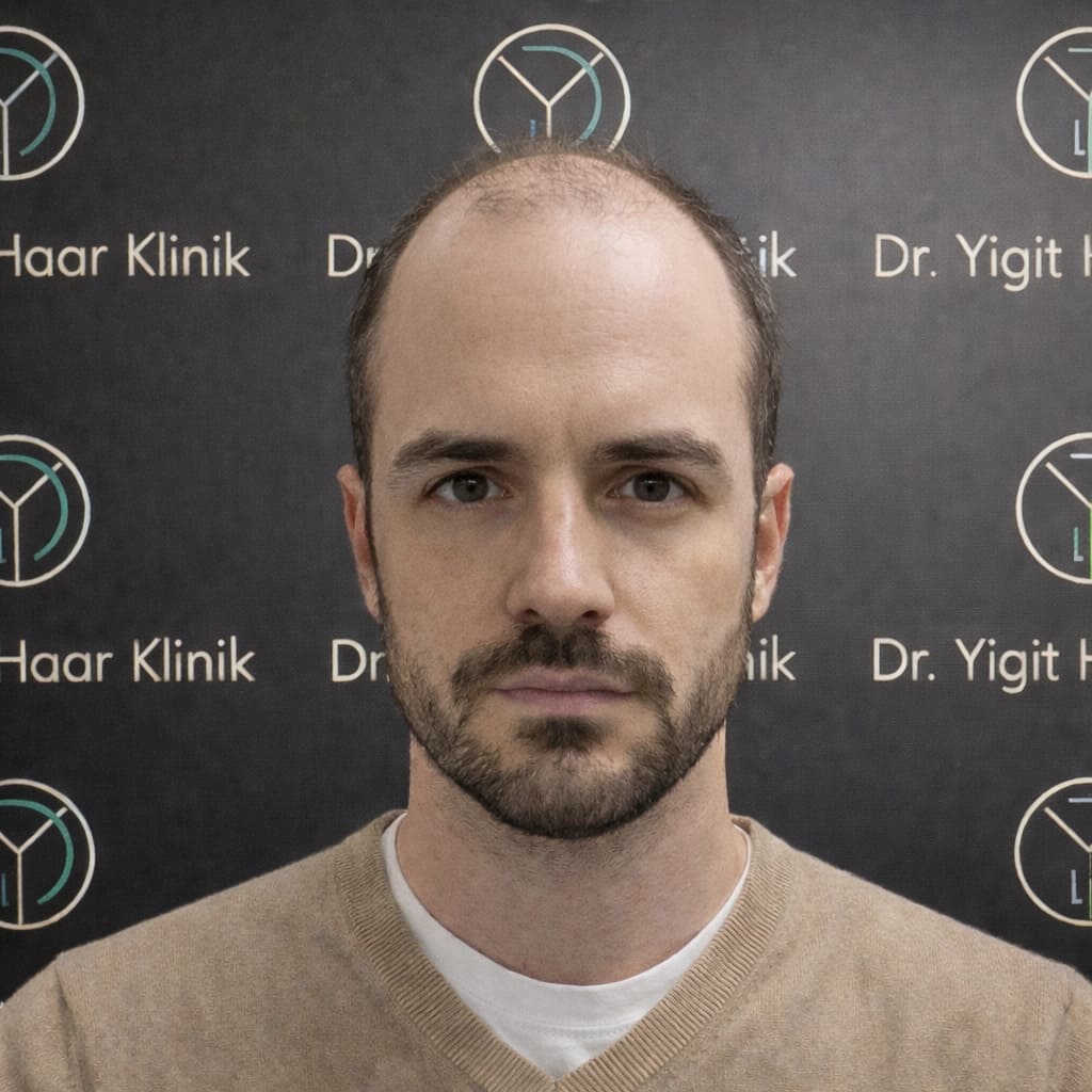 Mann vor Haartransplantation mit Geheimratsecken